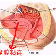 盆腔粘連