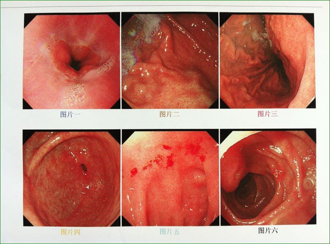 十二指腸球後潰瘍