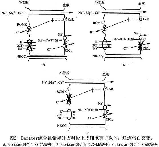 先天性醛固酮增多症