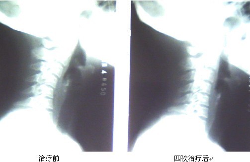 頸椎反弓治療對比圖