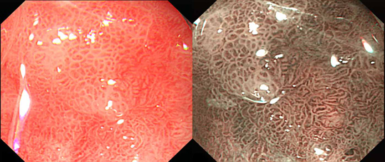 NBI與普通內鏡成像