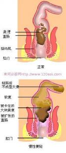 結腸易激綜合徵(腸激綜合徵)