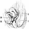 便稀時經陰道排出