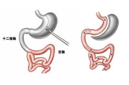 手術減重