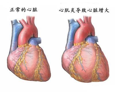 特異性心肌病