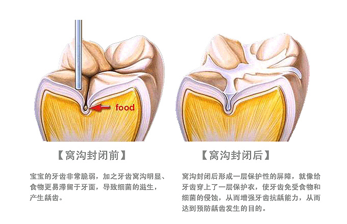 什麼是窩溝封閉