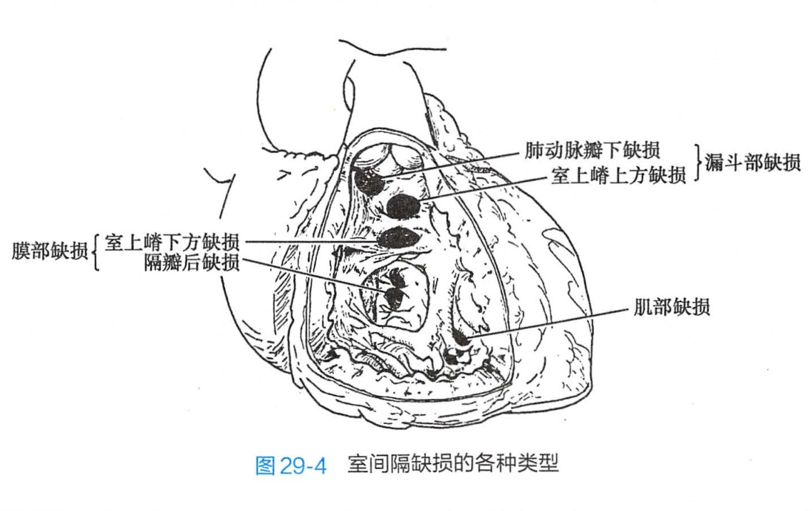 室間隔缺損