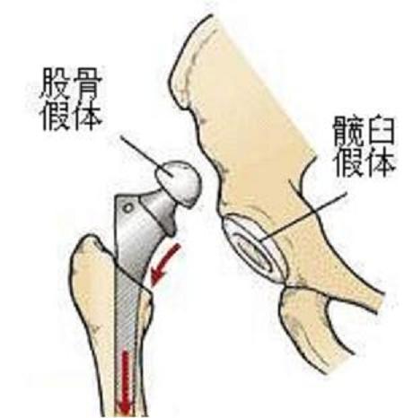 髖關節置換示意圖