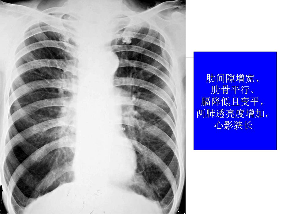 慢性阻塞性肺疾病肺氣腫