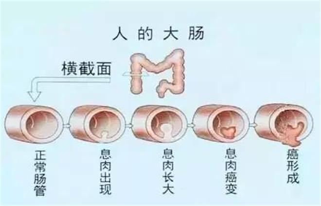 結直腸息肉病