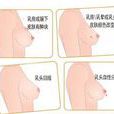 乳房脂肪瘤