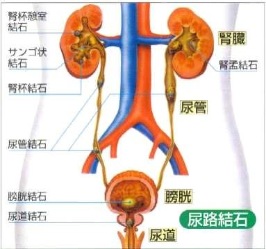 鈣結石