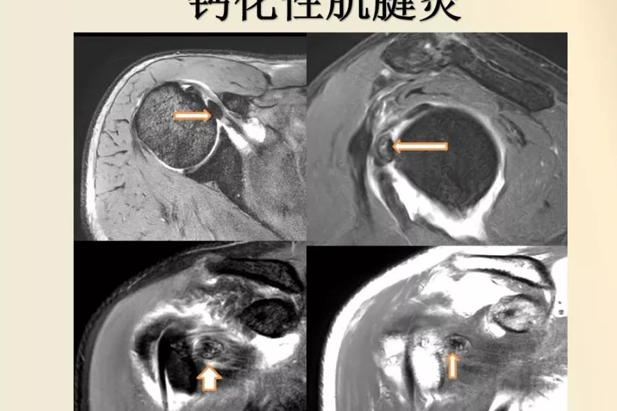 鈣化性岡上肌腱炎