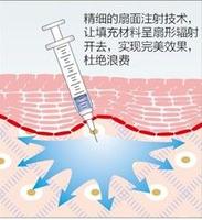 扇面注射技術