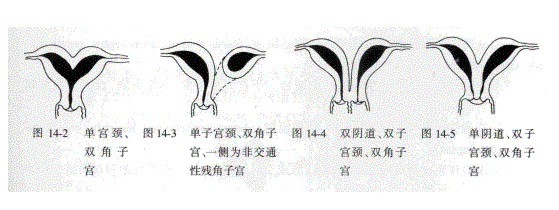 單角或雙角子宮