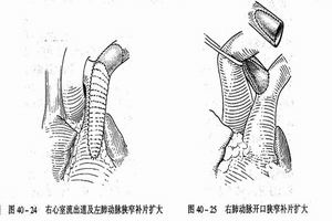 左室流出道阻塞