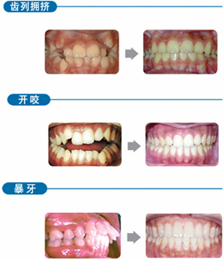 牙齒矯治