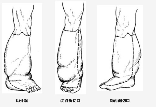 下肢象皮腫手術