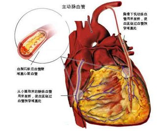 名醫講堂：冠心病