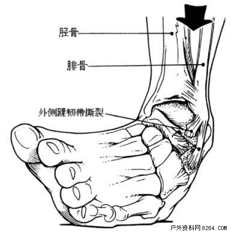 腳踝骨裂