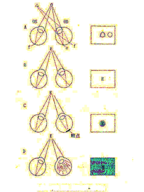 弱視眼的擁擠現象