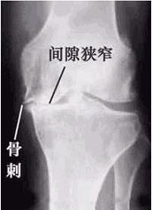 患骨刺關節X光片