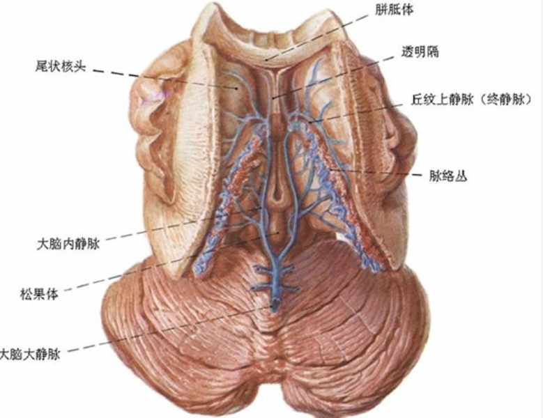 大腦大靜脈瘺