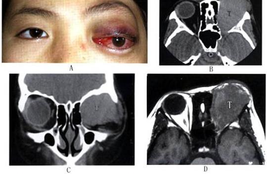 眼眶惡性腫瘤