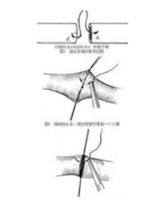 神經外膜縫合術