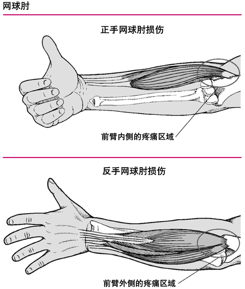 肱骨外上髁炎損傷疼痛區