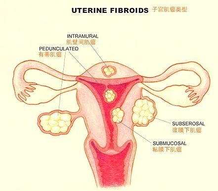 惡性子宮肌瘤