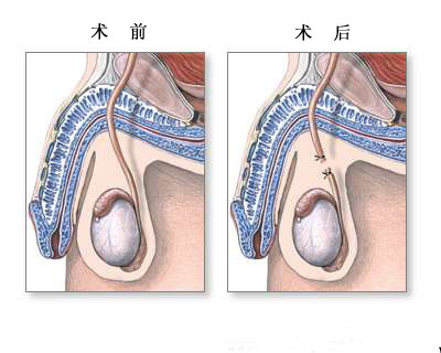 輸精管結紮術