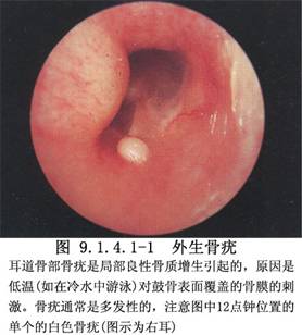 外耳道良性腫瘤切除術