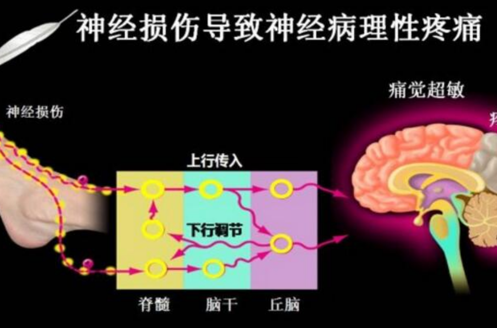 神經病理性疼痛