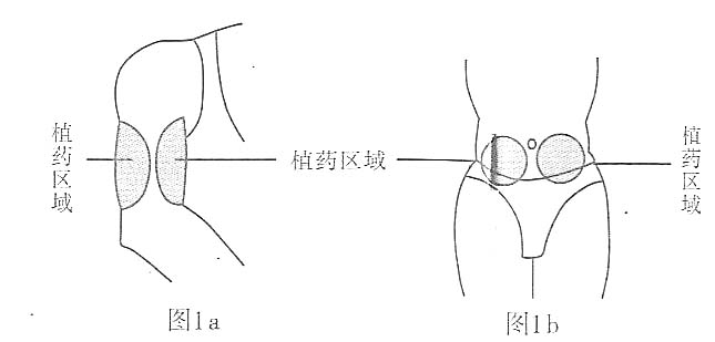 氟尿嘧啶植入劑