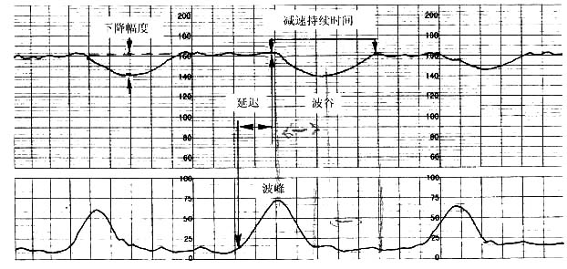 圖2 胎心監護曲線圖形面積分析法圖示5