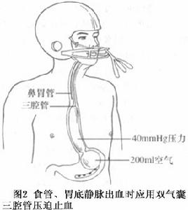 圖2 門脈高壓症