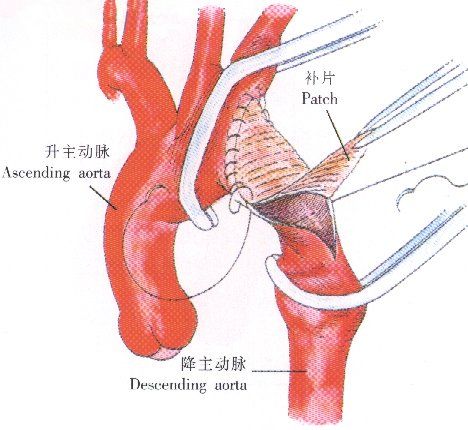 心肌補片