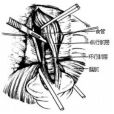 經腹途徑食道肌層切開術