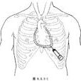 心包腔穿刺術