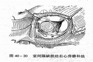 左室流出道阻塞