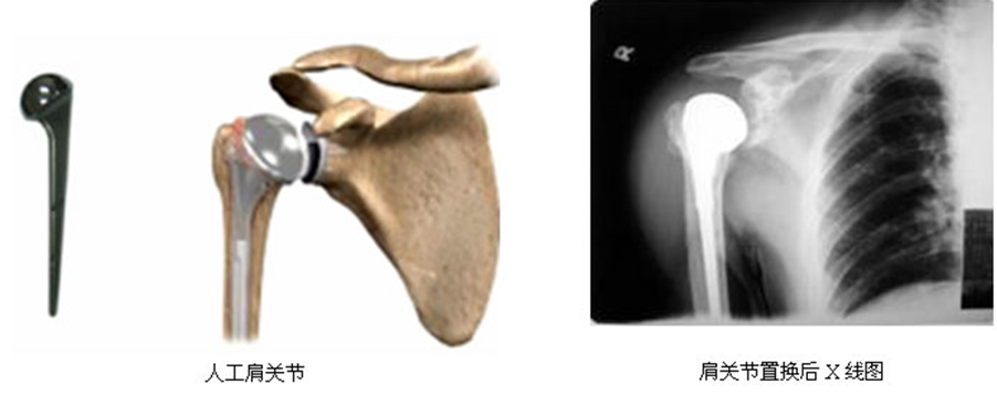 人工肩關節