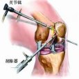 關節粘連松解灌洗術