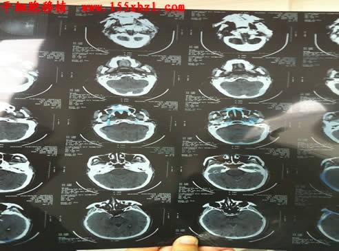 多發性腦梗塞