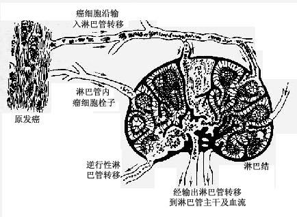 瘤細胞栓子