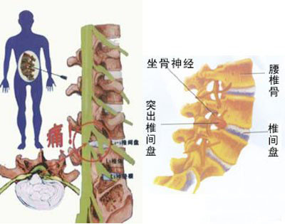 腰椎間盤突出症