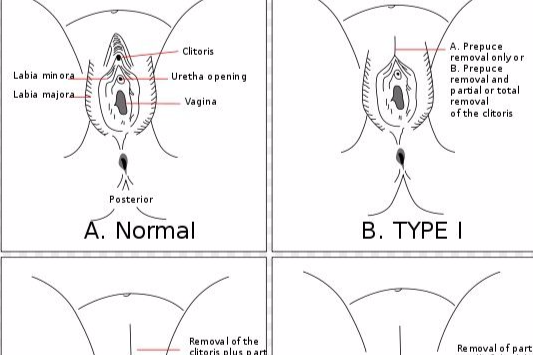 女性生殖器損毀/切割