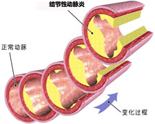 多動脈炎腎損害病