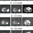 磁共振彌散加權成像