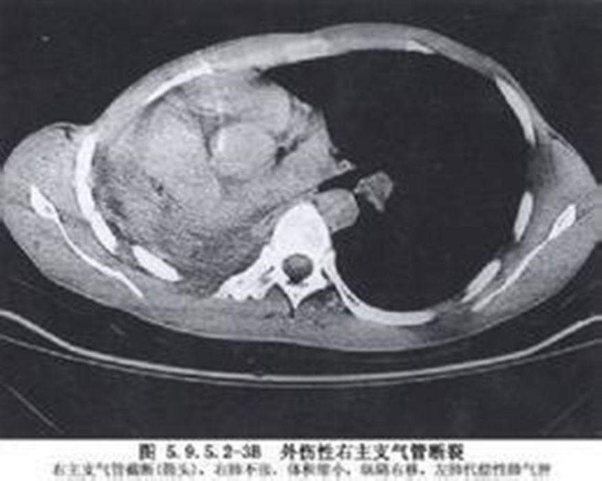 氣管及支氣管破裂修復術